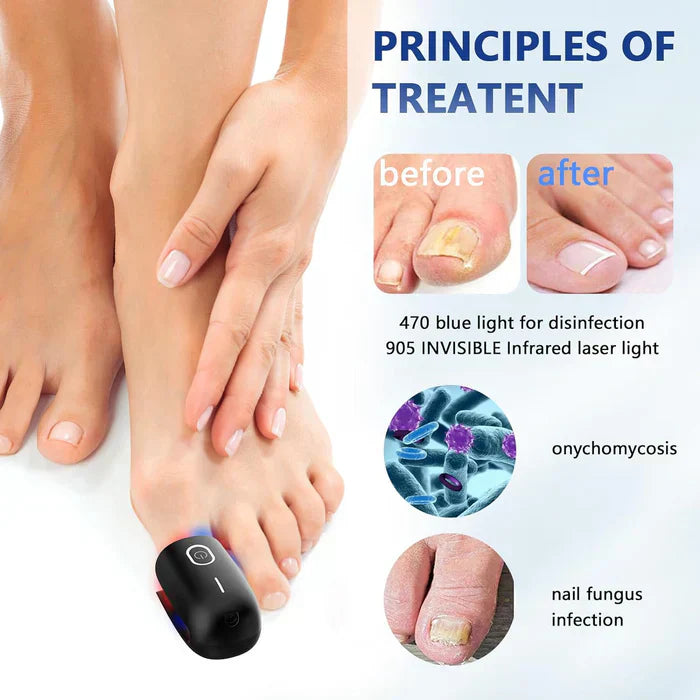 Laser Treatment Device for Toenail Fungus Therapy