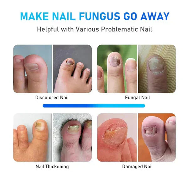 Nail Fungus Laser Treatment Device for Onychomycosis