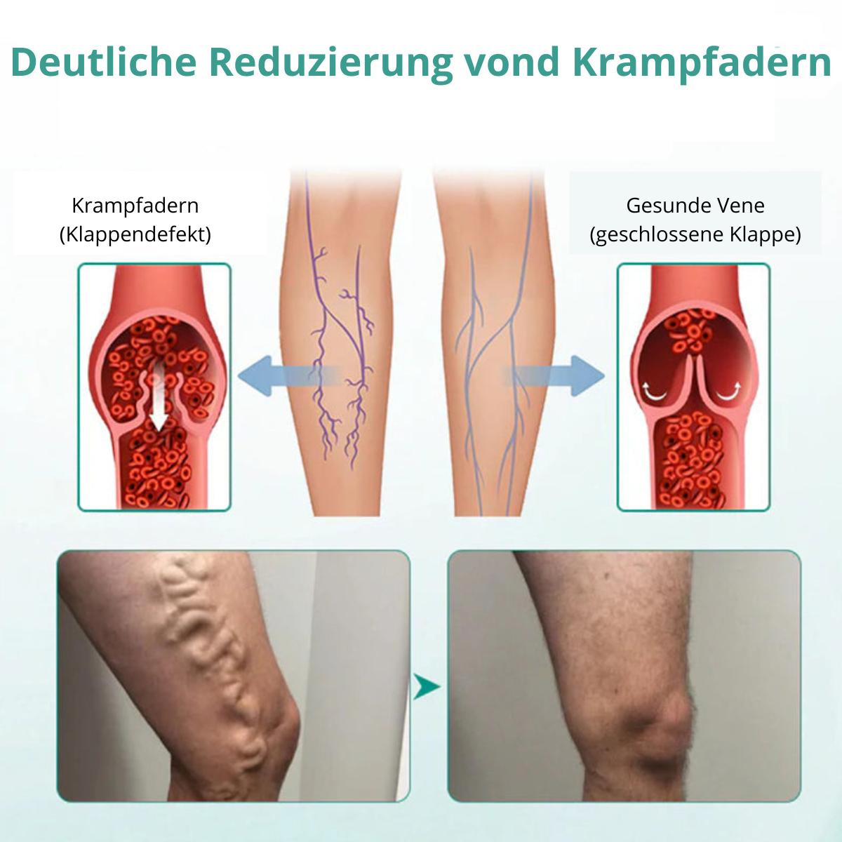VenoLift Patches – Relief for Painful, Visible Veins