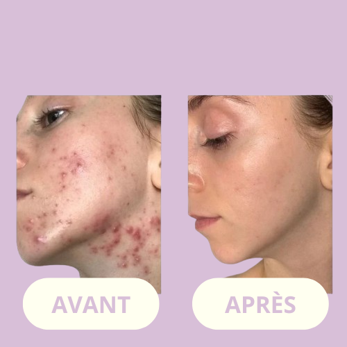 ClearSkin Wand™