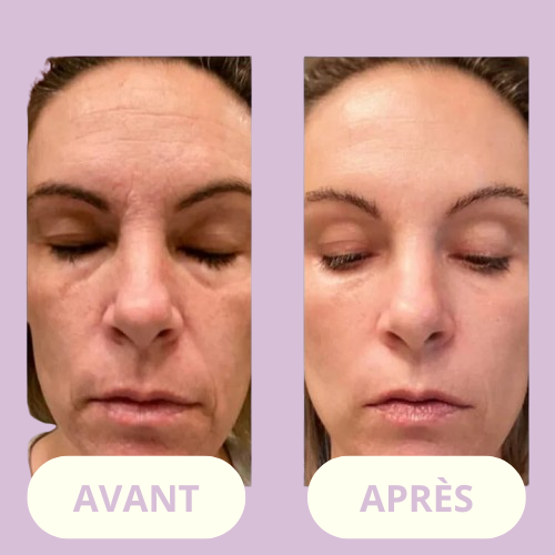 ClearSkin Wand™