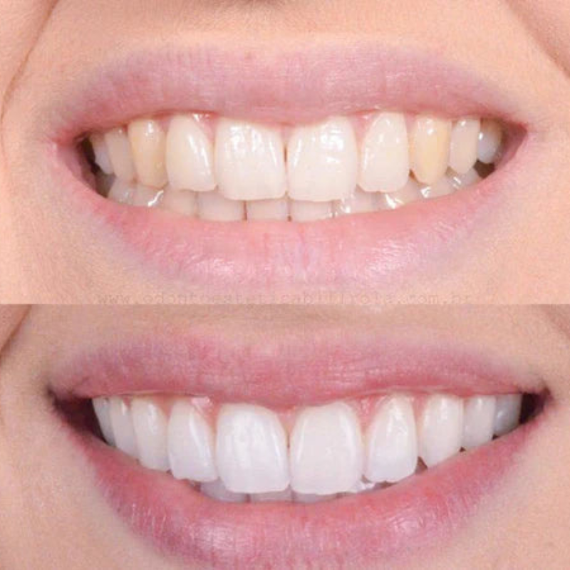 LumiWhite Glow™ — Unlock a Pain-Free, Dazzling Smile That Commands Attention