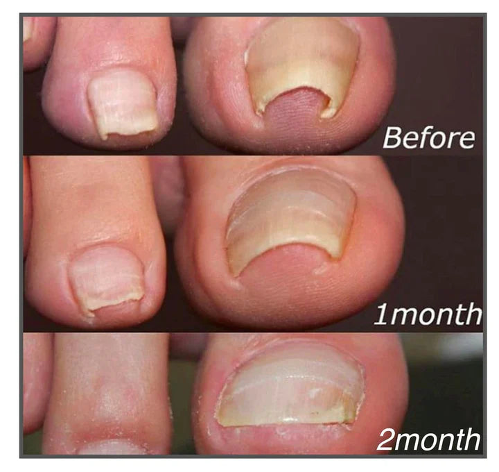 PediAlign™ — End Nail Pain and Reveal Beautiful, Confident Feet Again