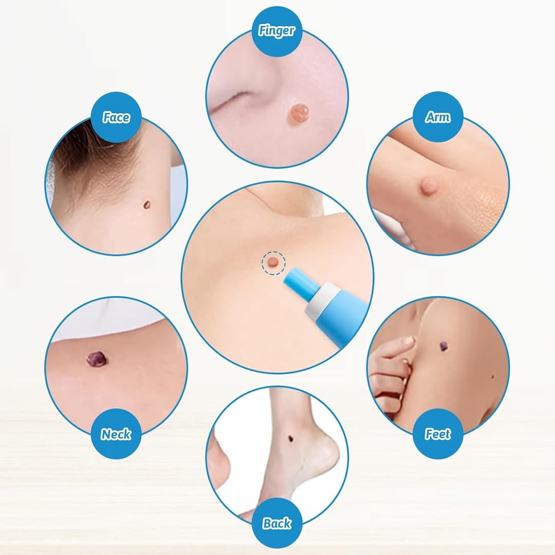 DermaLift™ — Experience Painless Skin Tag Freedom and Radiate Confidence Quickly