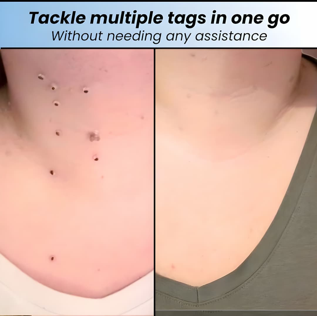 DermaLift™ — Experience Painless Skin Tag Freedom and Radiate Confidence Quickly