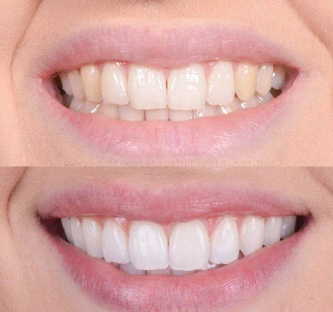 RadiancePro™ Teeth Whitener — Instantly Brighten Your Smile Without Sensitivity