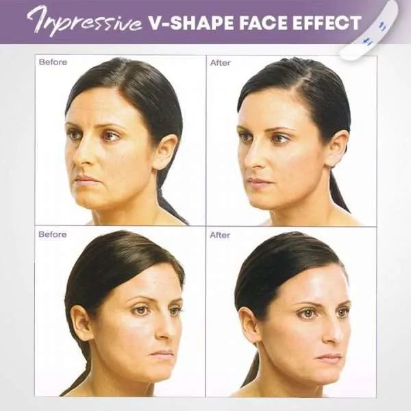 Invisible Face-Lift Kit (40 pieces)