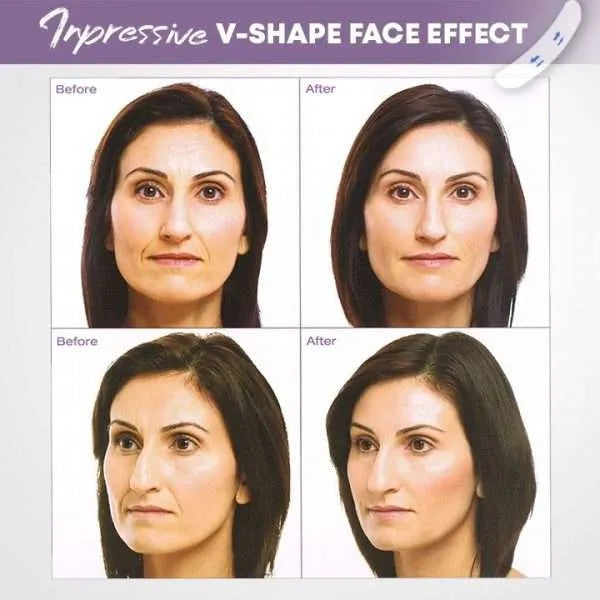 Invisible Face-Lift Kit (40 pieces)