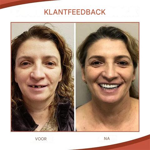 SilsoftEase™ — Slip Into Pain-Free Dentures That Feel Made Just for You