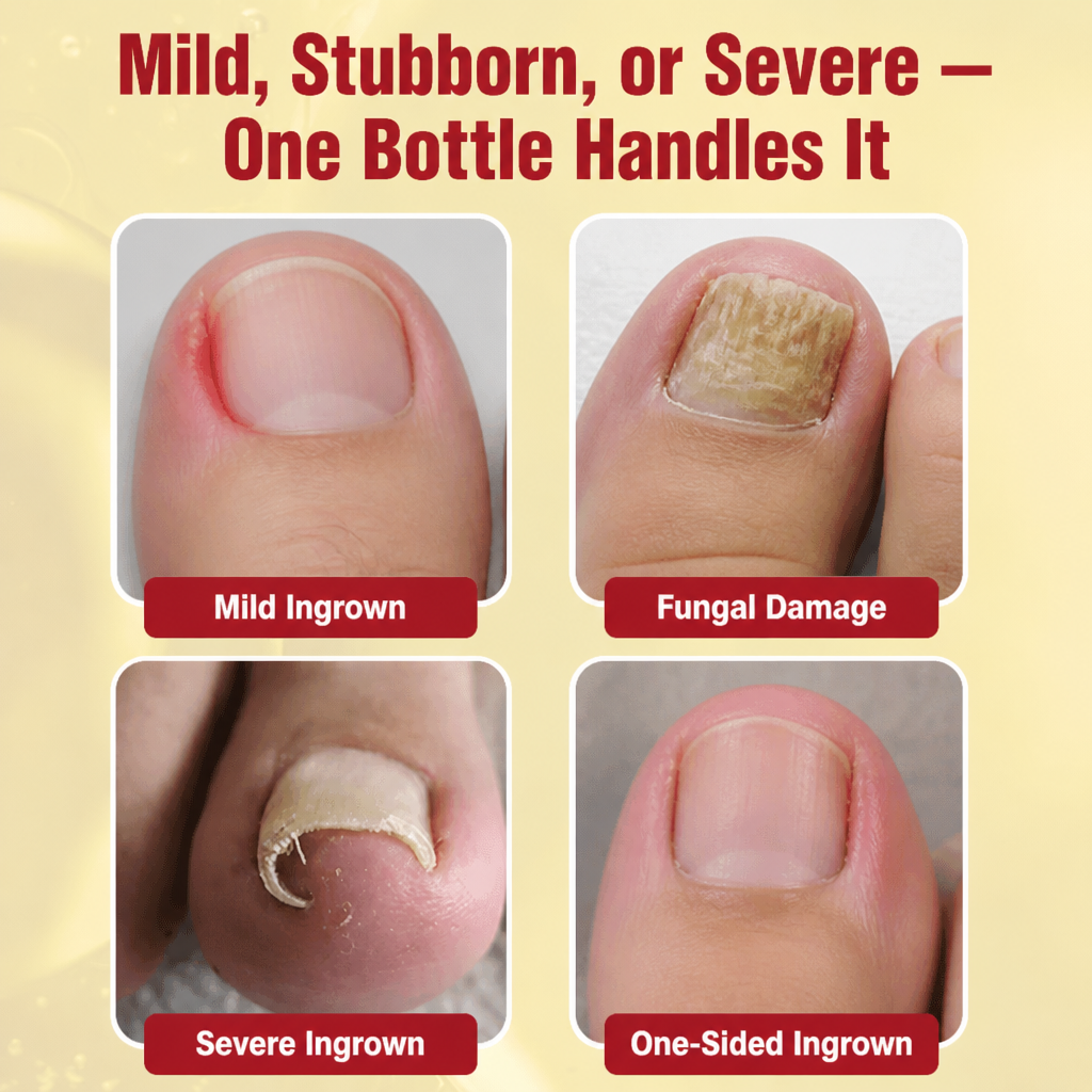 NailFortify™ — Soothe Painful Ingrown Toenails and Fungal Damage at Home